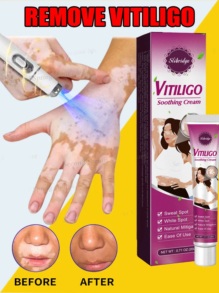 Herbal Extract Vitiligo Ointment Remove Ringworm White Spot Removal Skin Vitiligo Eliminate Vitiligo Treatment Cream