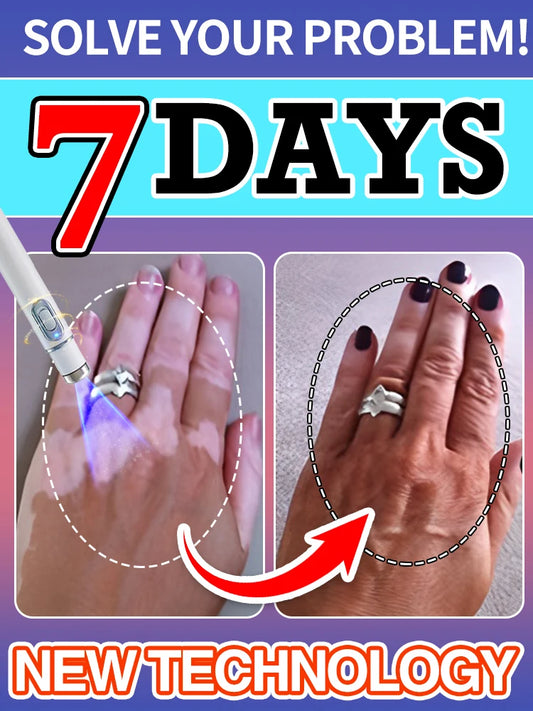 Herbal Extract Vitiligo Ointment Remove Ringworm White Spot Removal Skin Vitiligo Eliminate Vitiligo Treatment Cream