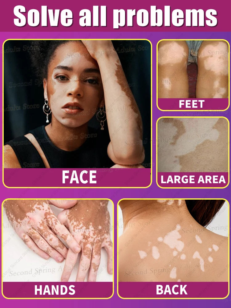 Herbal Extract Vitiligo Ointment Remove Ringworm White Spot Removal Skin Vitiligo Eliminate Vitiligo Treatment Cream